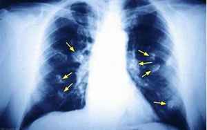 为什么肺部结节的人越来越多
