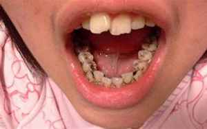 宝宝乳牙门牙是八字型