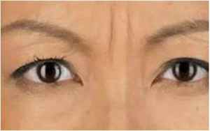 女人眉间有一道竖纹代表什么