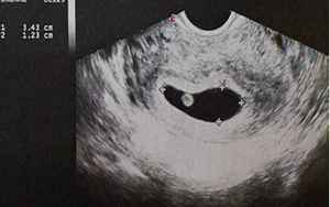 孕囊大小看性别已验证(孕期通过b超单看孕囊大小、形状可以辨别性别)