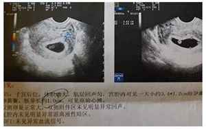 胎囊形状看男女(超准)(7周B超单的3个数据)