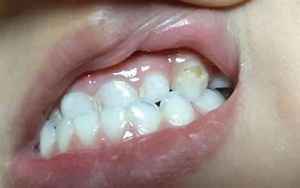 宝宝乳牙门牙是八字型(小孩换好的门牙张成八字形怎么办)