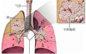 早期肺癌症状(早期的肺癌症状有哪些)